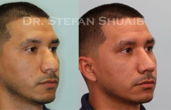 male patient before and after Rhinoplasty