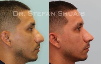 male patient before and after Rhinoplasty