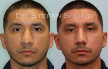 male patient before and after Rhinoplasty