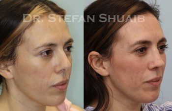 female patient before and after Rhinoplasty