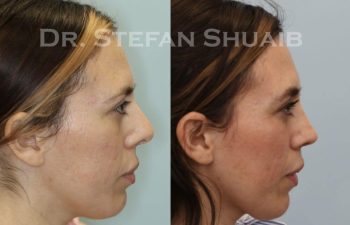 female patient before and after Rhinoplasty