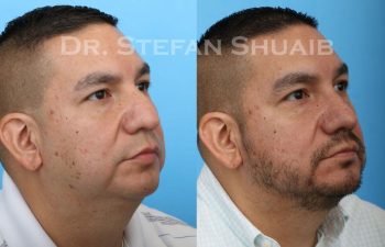 male patient before and after Rhinoplasty