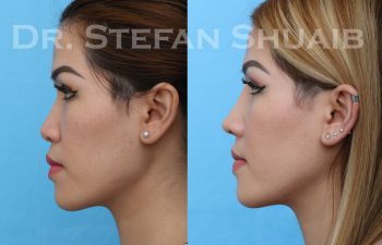 female patient before and after asian rhinoplasty procedure