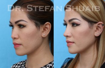 female patient before and after asian rhinoplasty procedure