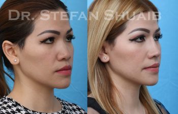 female patient before and after asian rhinoplasty procedure