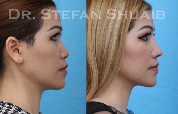 female patient before and after asian rhinoplasty procedure