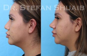 female patient before and after rhinoplasty