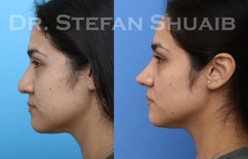 female patient before and after Rhinoplasty