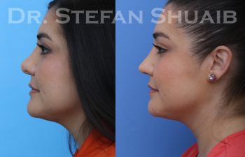revision rhinoplasty before and after