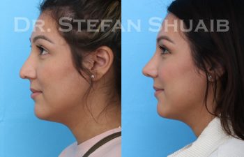 female patient before and after asian rhinoplasty procedure