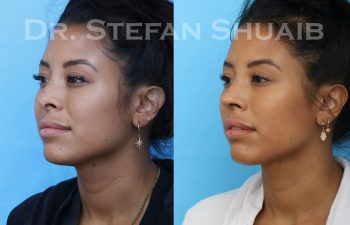 female patient before and after asian rhinoplasty