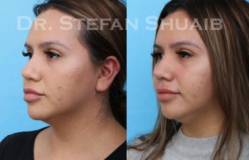 female patient before and after rhinoplasty