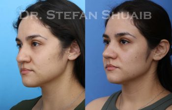 female patient before and after Rhinoplasty