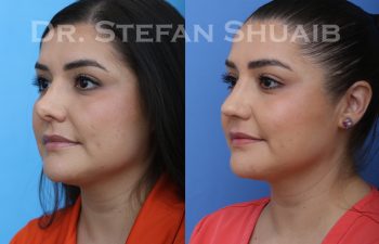 revision rhinoplasty before and after