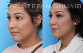 female patient before and after asian rhinoplasty procedure