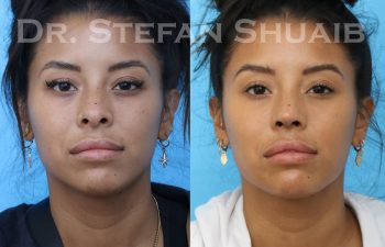 female patient before and after asian rhinoplasty