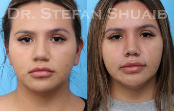 female patient before and after rhinoplasty