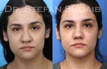 female patient before and after Rhinoplasty