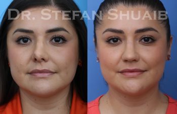 revision rhinoplasty before and after