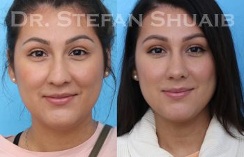 female patient before and after asian rhinoplasty procedure