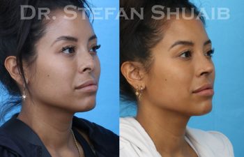 female patient before and after asian rhinoplasty