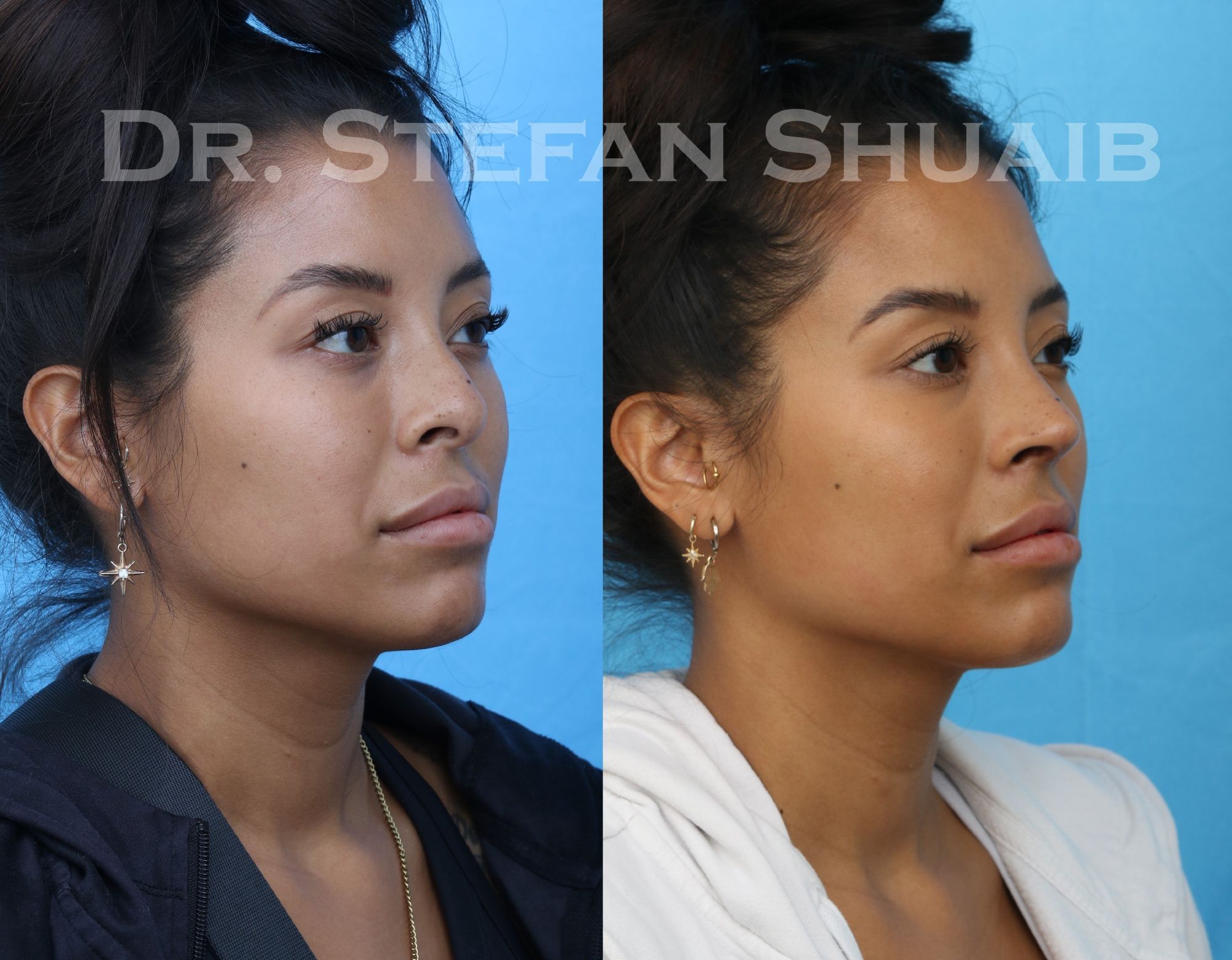 female patient before and after asian rhinoplasty