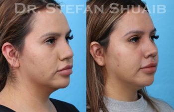 female patient before and after rhinoplasty