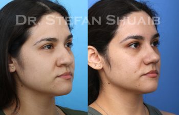 female patient before and after Rhinoplasty