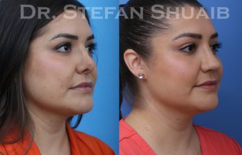 revision rhinoplasty before and after