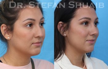 female patient before and after asian rhinoplasty procedure