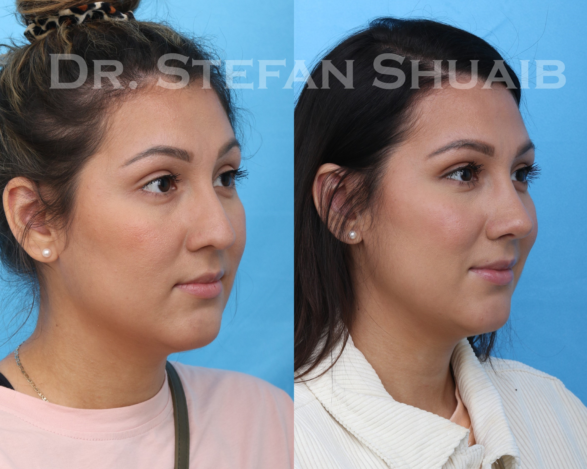 female patient before and after asian rhinoplasty procedure