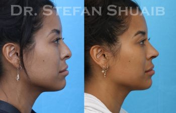 female patient before and after asian rhinoplasty