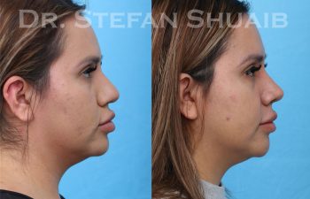 female patient before and after rhinoplasty