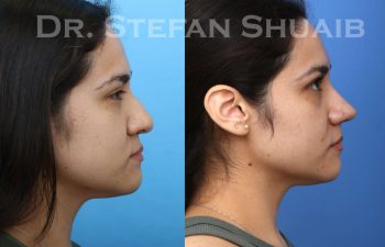 female patient before and after Rhinoplasty