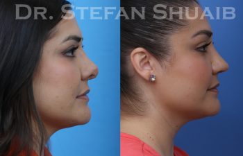 revision rhinoplasty before and after