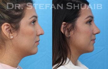 female patient before and after asian rhinoplasty procedure