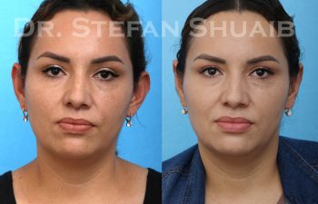 female patient before and 1 month after otoplasty