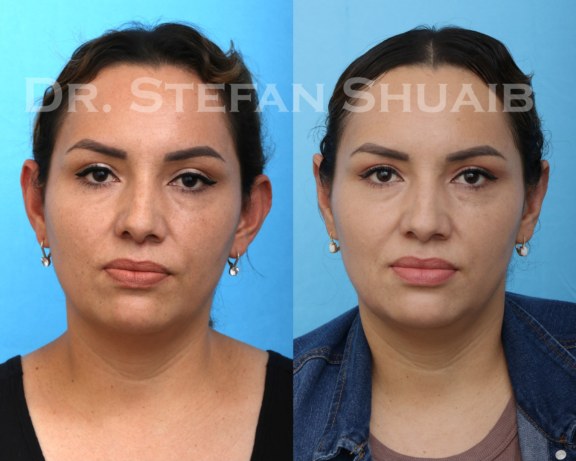 female patient before and 1 month after otoplasty