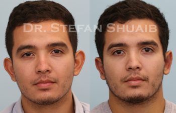male patient before and 1 week after otoplasty