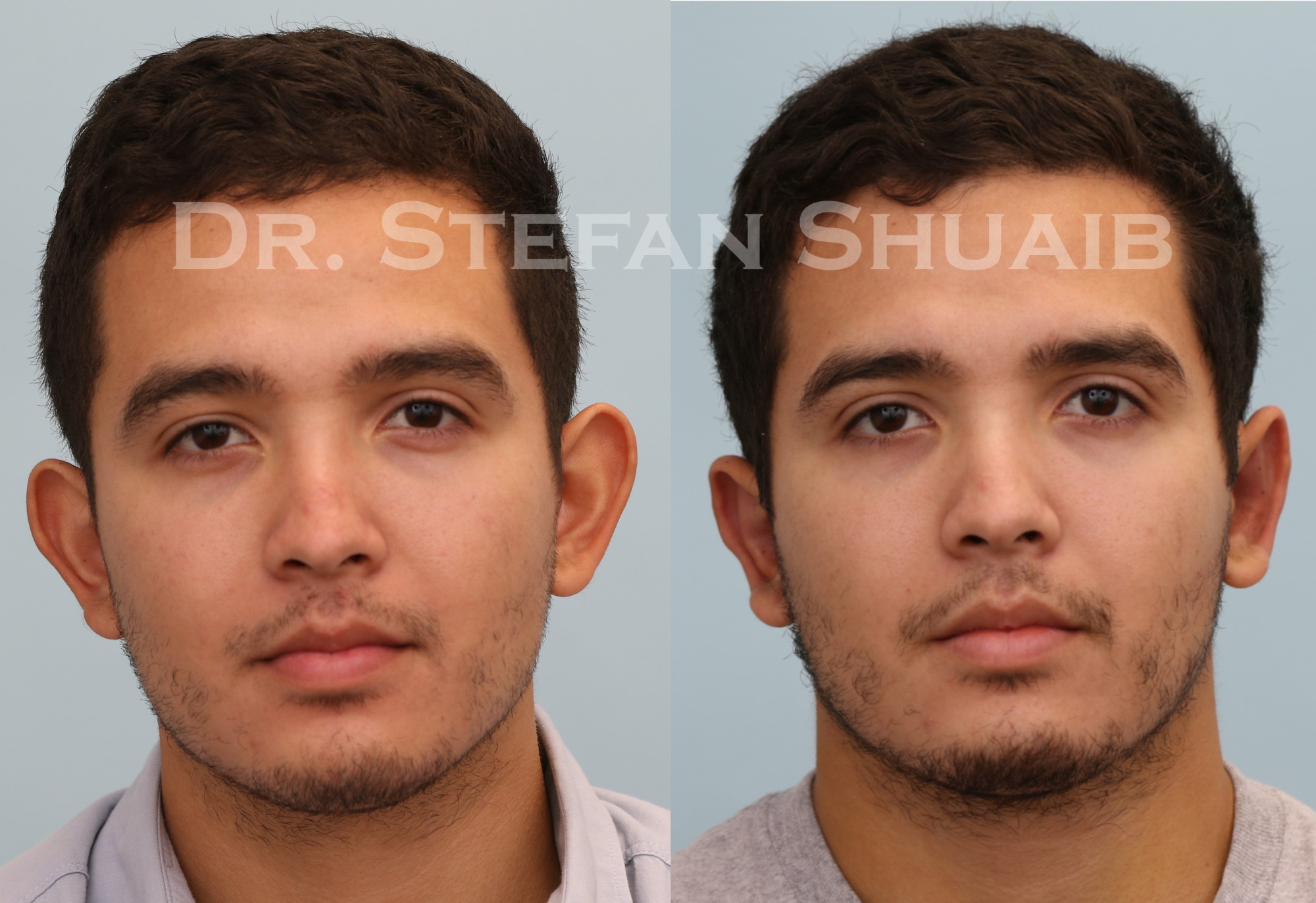 male patient before and 1 week after otoplasty
