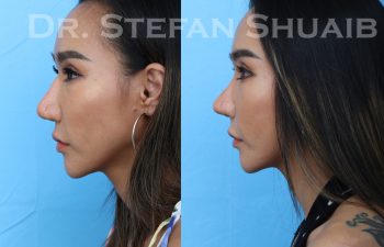 female patient before and after asian rhinoplasty procedure