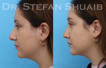 female patient before and after rhinoplasty