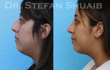 female patient before and after rhinoplasty