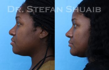 female patient before and after african american rhinoplasty procedure