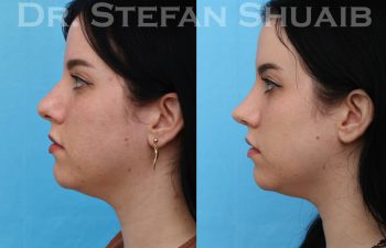 female patient before and after rhinoplasty