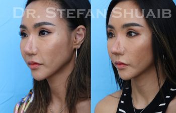 female patient before and after asian rhinoplasty procedure