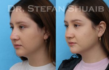 female patient before and after rhinoplasty