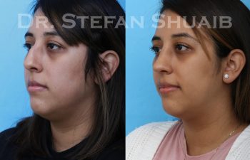 female patient before and after rhinoplasty