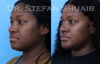 female patient before and after african american rhinoplasty procedure