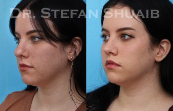 female patient before and after rhinoplasty